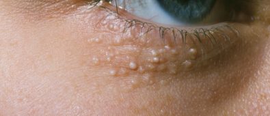 Cum puteti sa scapati de mila