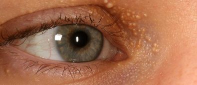 Prin ce difera milia de alte tipuri de pori infundati