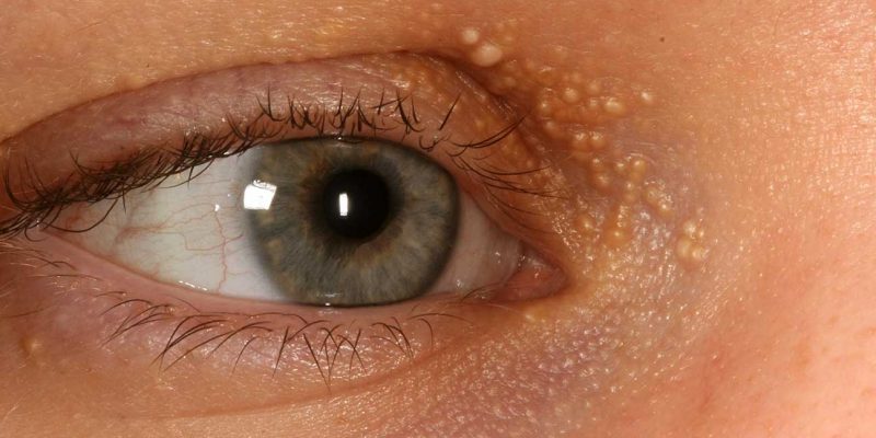 Prin ce difera milia de alte tipuri de pori infundati